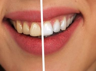 Viver Bem: Uso de Lentes de Contato nos dentes despertam para o cuidado com a saúde bucal