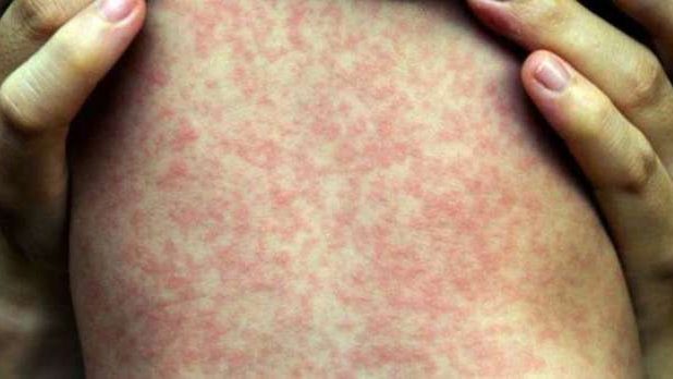 Mais de 1.220 casos de sarampo já foram confirmados pelo Ministério da Saúde